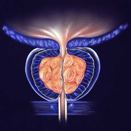 Cross-section illustration of stage 3 benign prostatic hyperplasia