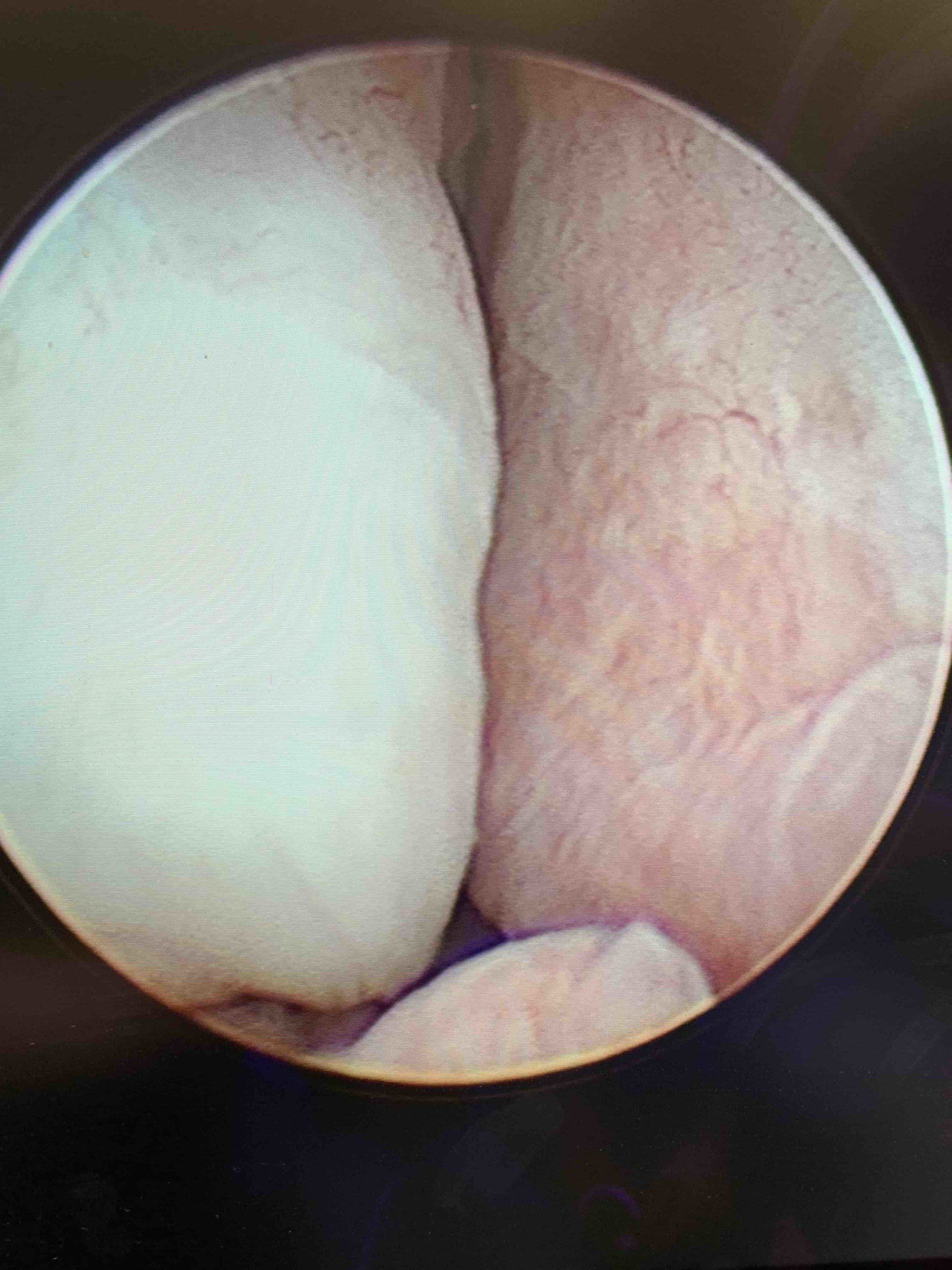 Endoscopic view illustrating enlarged prostate tissue