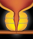 UroLift implants holding the prostate lobes apart