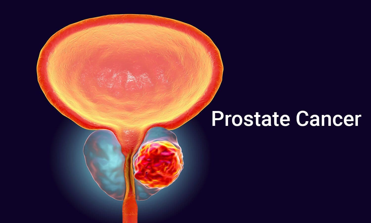 Medical illustration representing a prostate cancer clinical trial