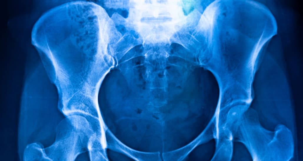 Hip X-ray style image used for the brachytherapy page