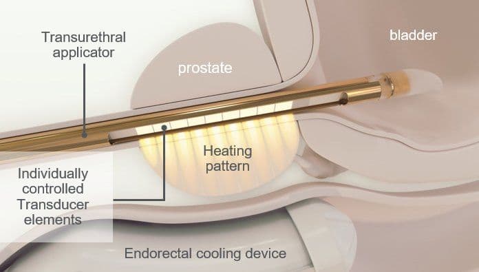 TULSA procedure diagram