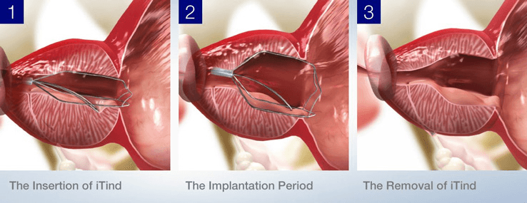 Three steps of iTind: insertion, implantation period, and removal, widening the prostatic urethra