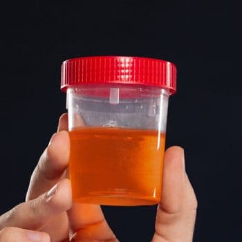 A urine sample cup showing discolored urine