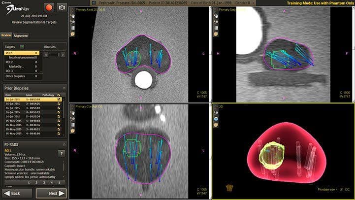Navigo software showing current and prior biopsy cores mapped on prostate imaging