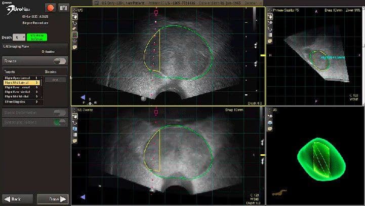 Navigo ultrasound-guided biopsy targeting interface